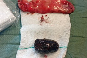 Laparoscopic removal of a 5 cm gallbladder stone