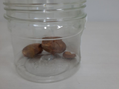 Specialized surgery to remove large bladder stones