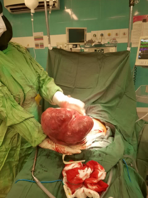 Successful removal of uterine myoma tumor weighing more than 5 kilograms