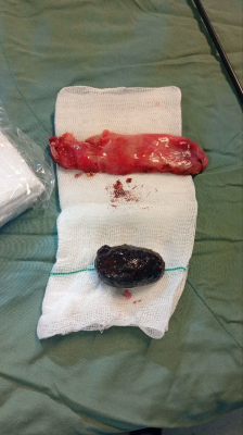 Laparoscopic removal of a 5 cm gallbladder stone