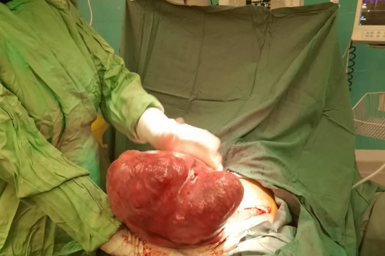 Successful removal of uterine myoma tumor weighing more than 5 kilograms