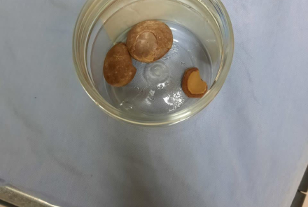 Specialized surgery to remove large bladder stones