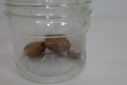 Specialized surgery to remove large bladder stones