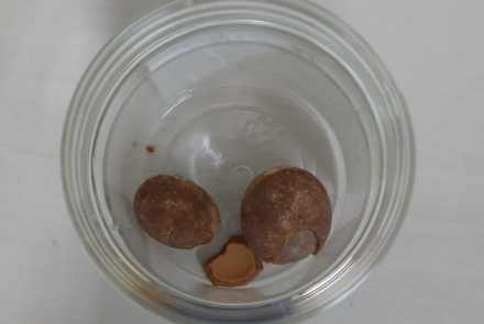 Specialized surgery to remove large bladder stones