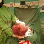 Successful removal of uterine myoma tumor weighing more than 5 kilograms