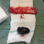 Laparoscopic removal of a 5 cm gallbladder stone
